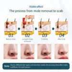 Freckles Removal Device - Image 3